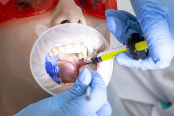 Una Ragazza Visita Dal Dentista Trattamento Della Carie Medico Utilizza — Foto Stock