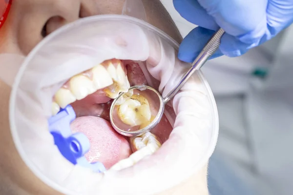 Una Ragazza Ricevimento Dal Dentista Trattamento Della Carie Sopra Carie — Foto Stock