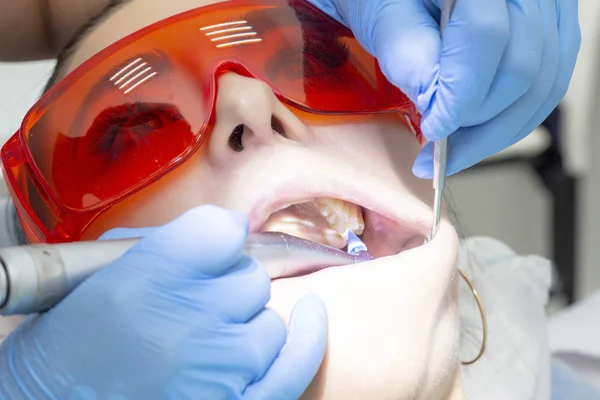 Пациентка Приеме Дантиста Лечение Кариозного Зуба Девушка Лежит Стоматологическом Стуле — стоковое фото