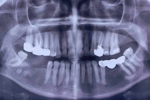 Ortotomografia Dorosłego Pacjenta Prześwietlenie Panoramiczne Korona Dentystyczna — Zdjęcie stockowe