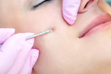 Yüzün derisini siyah noktalar ve sivilcelerden yapılmış kaşıkla temizleme işlemi..