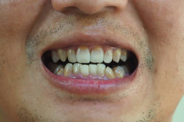 人間の口腔の健康の不健康な歯 歯が人間の口腔の健康を傾けた — ストック写真