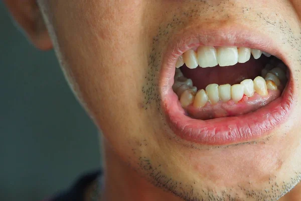 Unhealthy teeth Of human oral health , Teeth tilted human oral health