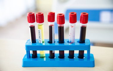 COVID-19, Corona Virüsü aşısı ve pozitif hasta enfeksiyonu. Laboratuvarda yeni Corona virüsü enfeksiyonu teşhisi için kan testi yapıldı.
