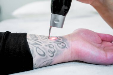 Bir hastanın kolunda büyük bir dövme Lazer dövme kaldırma, picosecond lazer teknolojisi kullanarak, bir güzellik ve tıbbi lazer kliniğinde. Teknisyen el parçasını tutuyor..
