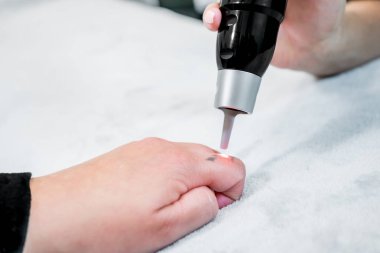 Picosecond lazer dövme kaldırma bir hastanın parmağında küçük bir siyah dövme, bir cilt bakım kliniğinde, lazer darbeleri uygulayan bir güzellik ile.