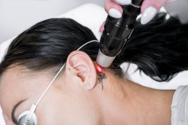 Lazer dövme kaldırma tedavi oturumu hasta, picosecond teknolojisini kullanarak, küçük parçacıklar halinde dövme mürekbi yıkmak için. Estetik lazerler için güzellik ve cilt bakım kliniğinde.