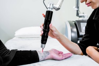 Bir hastanın kolunda büyük bir dövme Lazer dövme kaldırma, picosecond lazer teknolojisi kullanarak, bir güzellik ve tıbbi lazer kliniğinde. Teknisyen el parçasını tutuyor..