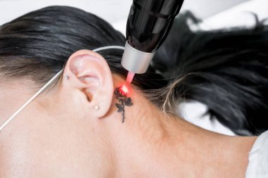 Lazer dövme kaldırma tedavi oturumu hasta, picosecond teknolojisini kullanarak, küçük parçacıklar halinde dövme mürekbi yıkmak için. Estetik lazerler için güzellik ve cilt bakım kliniğinde.