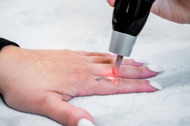 Picosecond lazer dövme kaldırma bir hastanın parmağında küçük bir siyah dövme, bir cilt bakım kliniğinde, lazer darbeleri uygulayan bir güzellik ile.