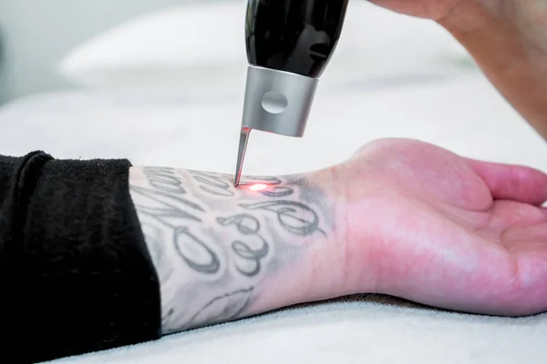 Rimozione del tatuaggio laser di un grande tatuaggio sul braccio di un paziente, utilizzando la tecnologia laser picosecondo, in una clinica laser di bellezza e medica. Il tecnico sta tenendo il manipolo . — Foto Stock