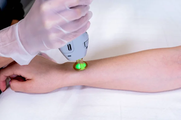 Primo piano della sessione di depilazione laser del braccio con il tecnico di bellezza e paziente femminile, epilante dopo la rasatura, in una clinica cosmetologica della pelle . — Foto Stock
