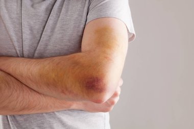 Ön kol, dirsek ve kol büyük çürük olan yakışıklı adam. Spor yaralanma.