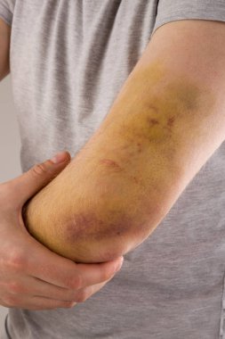 Ön kol, dirsek ve kol büyük çürük olan yakışıklı adam. Spor yaralanma.