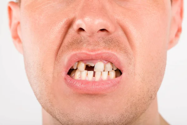 Foto Ravvicinata Giovane Con Denti Mancanti Abuso Droghe Malattie Igiene — Foto Stock