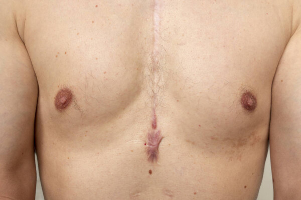 Open heart surgery scar