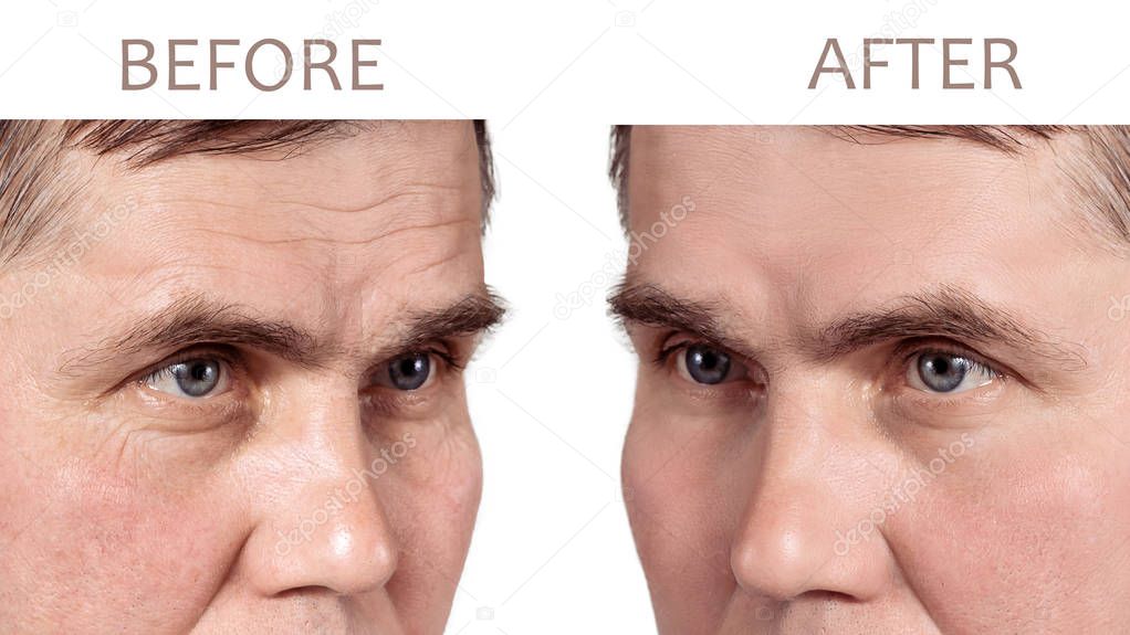 Face of a mature man before and after cosmetic rejuvenating procedures