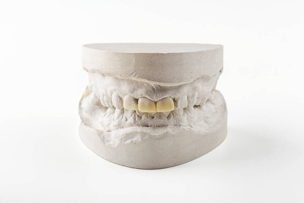 Stomatologic plaster cast, molds of human jaws and teeth on white background. Dental casting gypsum for manufacture of dentures, braces or false teeth. Dentistry and orthodontics concept.