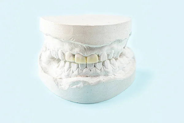 Gesso Estomatológico Moldes Mandíbulas Humanas Dentes Fundo Azul Gesso Fundição — Fotografia de Stock