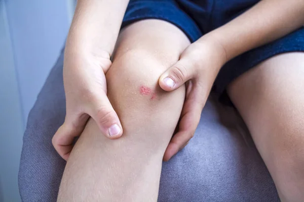 Kind Behandelt Wunden Knie Mit Wattepad Und Peroxid Bein Des — Stockfoto