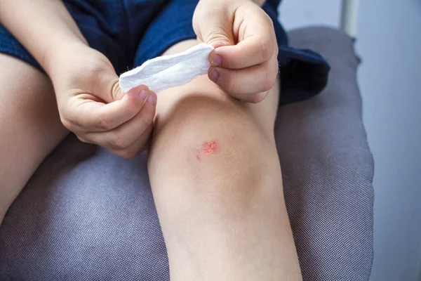 Niño Trata Herida Rodilla Con Almohadilla Algodón Peróxido Pierna Del —  Fotos de Stock