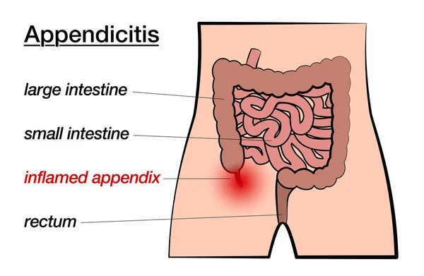 Blindtarmsinflammation inflammerad Appendix märkt Chart — Stock vektor
