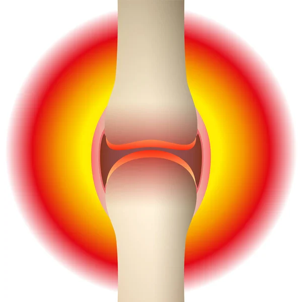 Joint pain - schematic anatomical graphic of a synovial joint with arthritis, rheumatism, gout, osteoarthritis or inflammation. Isolated vector illustration on white background. — Stock Vector