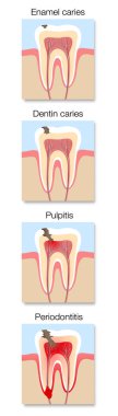Taşıyıcı gelişim bilgileri, diş çürüğünün enine kesitli aşamaları diş minesi ve dentin kabartmaları, pulpitis ve periodontit. Beyaz üzerine vektör illüstrasyonu.