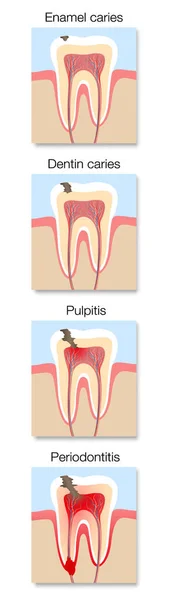 Infografía Desarrollo Caries Estadios Con Sección Transversal Caries Dental Con — Vector de stock