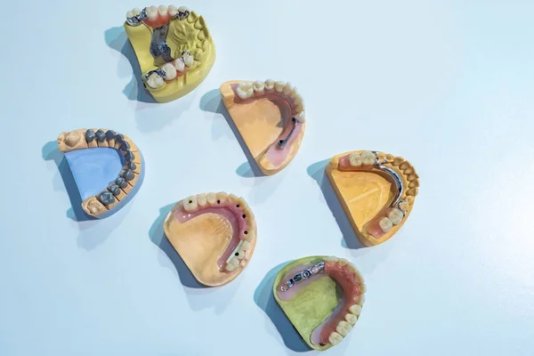 Models of jaws on a white table. Implantation. Prosthetics. Installation of dental crowns. Treatment of caries. Installation of dental implants. Correction of bite. Exodontia.