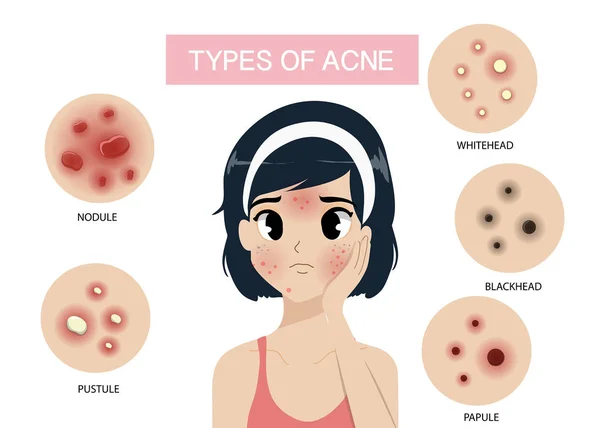 Types of acne — Stock Vector
