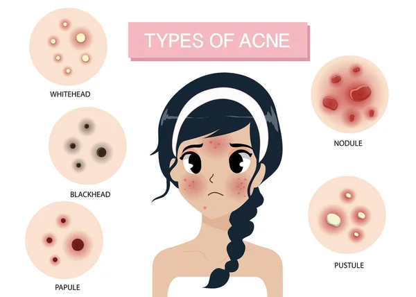 Tipos de acne —  Vetores de Stock