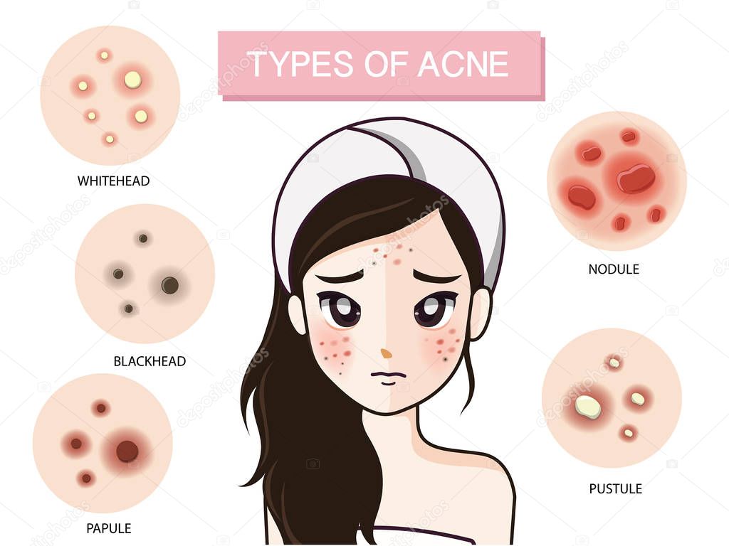 girl type of acne