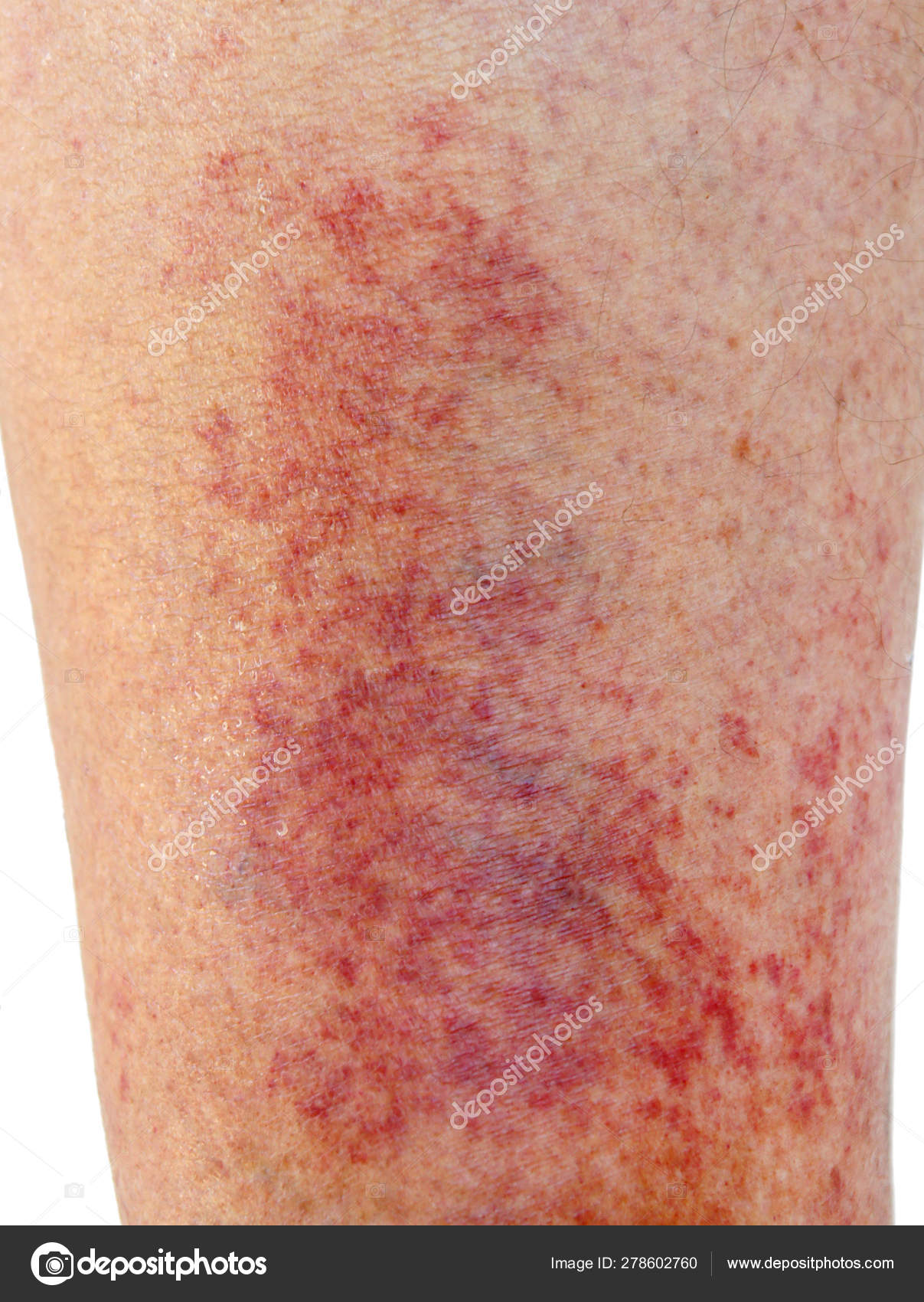 Dermatite de contact allergique au niveau du tibia — Photo de ...