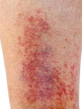Shin'de allerjik kontakt dermatit