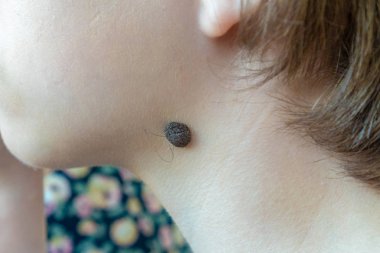 Bir çocuğun boynunda büyük doğum lekesi var. Kıllı köstebek