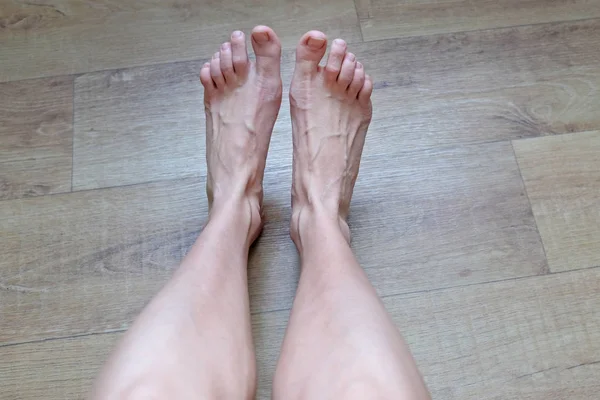 tired legs and feet of a young girl after wearing uncomfortable high-heeled shoes. swollen veins on the back of the feet top view. solving the problem of swollen and tired legs.
