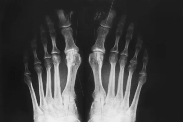 Radiographie du pied, déformation valgus de l'orteil — Photo