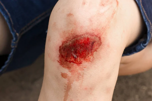 Broken scratched knee child — Stock Photo, Image