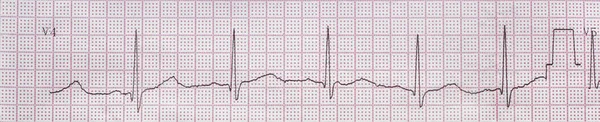 Eletrocardiograma Cardíaco Como Fundo — Fotografia de Stock