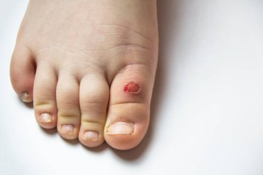 Küçük bir çocuğun bacağında nasır var. Çocuklar deride sorunlu bölgeler, kuru nasırlar, kötü tırnaklar. Nasırdan kaynaklanan bacak yarası..