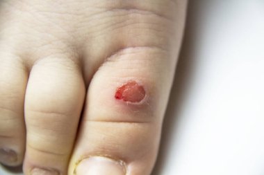 Küçük bir çocuğun bacağında nasır var. Çocuklar deride sorunlu bölgeler, kuru nasırlar, kötü tırnaklar. Nasırdan kaynaklanan bacak yarası..