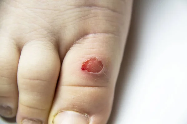 Callus on the leg of a young boy. children foot with problem areas on the skin, dry callus, bad nails. Leg wound from the callus.