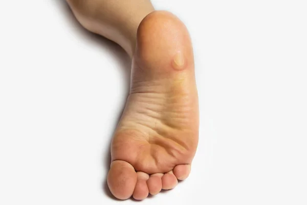 Velké Mozoly Noze Mladé Dívky Samičí Noha Mozolnatým Kožním Problémem — Stock fotografie