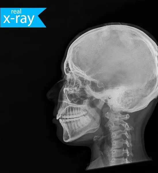 X-ray. A picture of a woman\'s skull. A real X-ray, medical background.