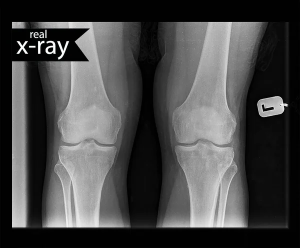 Lutut X Ray Stok Foto Lutut X Ray Gambar Bebas Royalti Halaman 22 Depositphotos