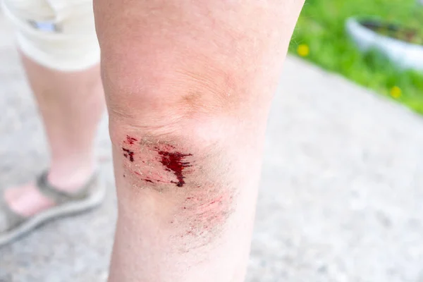 Damage Legs Outdoor Activities Fresh Untreated Bleeding Wound Knee Cleansed — Stock Photo, Image
