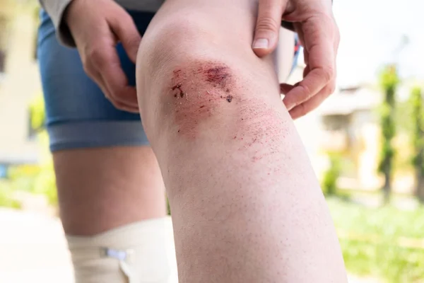 An open bleeding wound on the leg with cleansed skin, bruises and bruises. Damage to the legs during outdoor activities, running, cycling. Accident. Selective focus. Close-up.