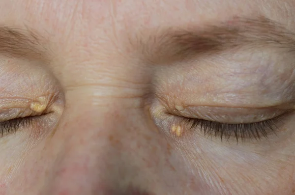 Close up of woman eyes with Xanthelasma on the eyelids. Hypercholesterolemia, high cholesterol. — Stock Photo, Image