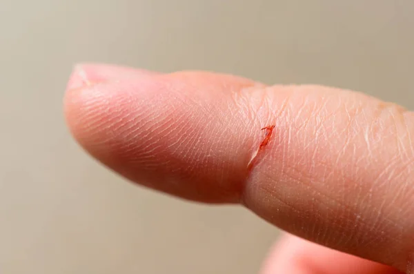 Відкрита розрізана рана на індексному пальці — стокове фото